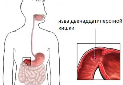 Metode de tratare a varicelor: foto, stadiu inițial, medicamente și remedii populare Yazva varikoz
